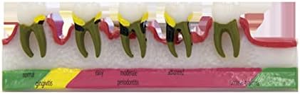 EWGAO 2 ADET Diş Patoloji Modeli, Periodontal Sınıflandırma Modeli, Doktor-Hasta İletişim Modeli, diş Hekimi Gösteri Aracı